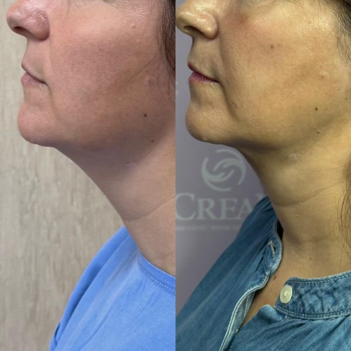 lip facial a