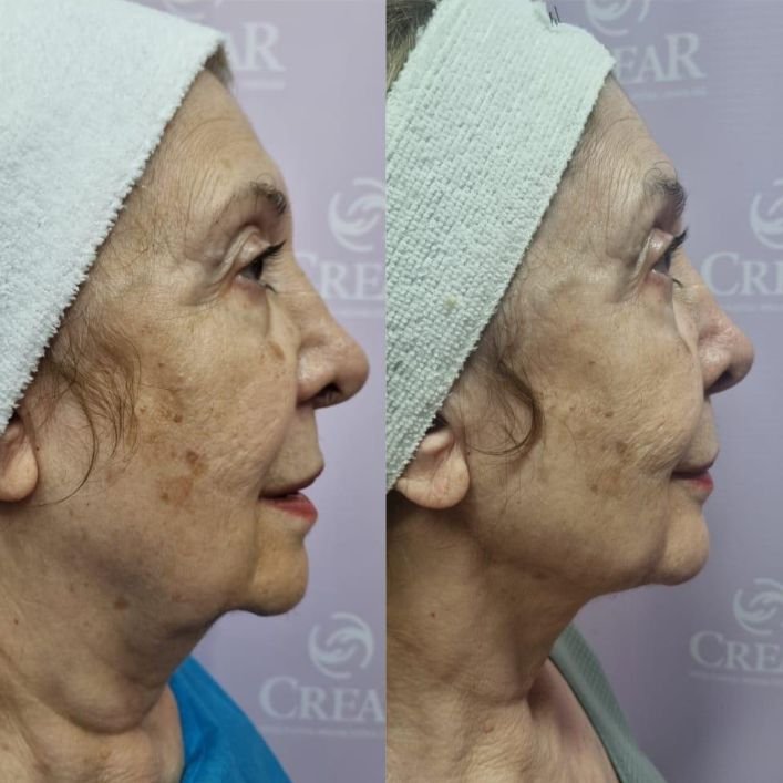 lip facial b