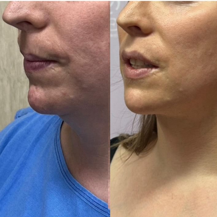 lip facial c